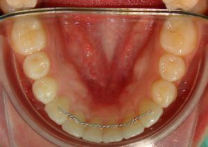 imagen muestra precio del retenedor fijo de ortodoncia